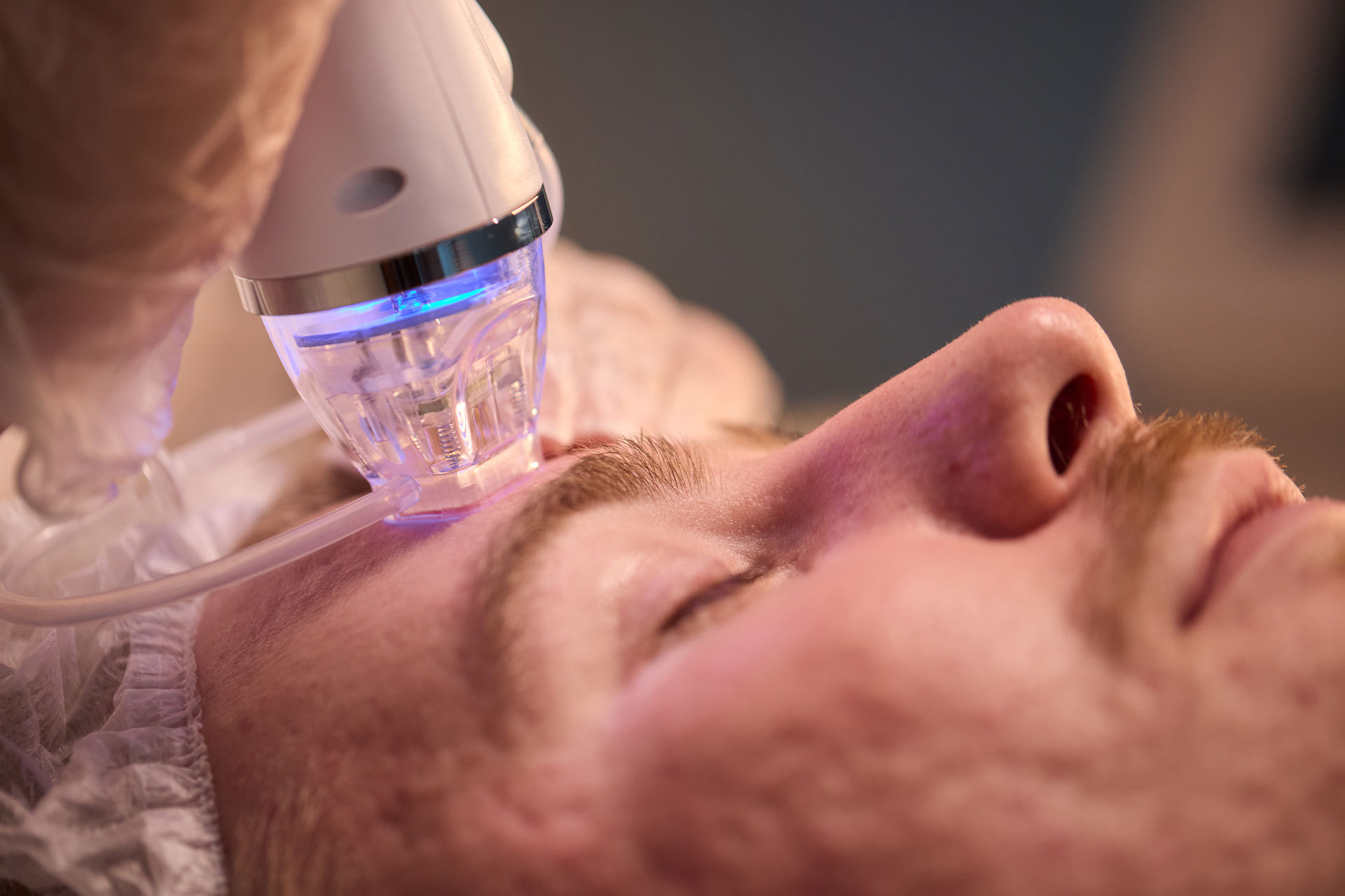 Small-Hero-Microneedling-Face-Man Microneedling